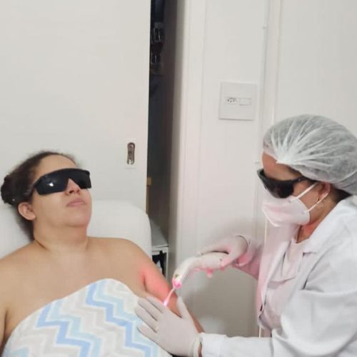 Aplicação de laserterapia para fissuras e lesões durante amamentação
